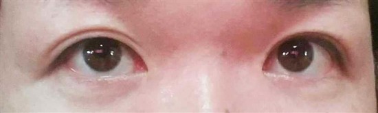 沖縄まつげエクステ・那覇まつげエクステ施術後の写真：くっきり目元でオシャレを演出
