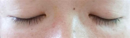 沖縄まつげエクステ・那覇まつげエクステ施術後の写真：くっきり目元でオシャレを演出