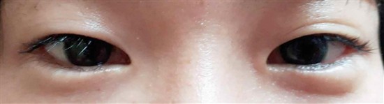 沖縄まつげパーマ・那覇まつげパーマ施術後の写真：まつげパーマ
