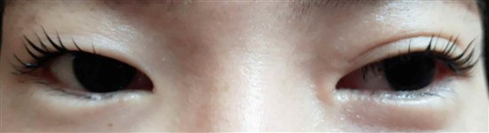沖縄まつげパーマ・那覇まつげパーマ施術後の写真：まつげパーマ