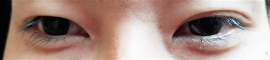 沖縄まつげエクステ・那覇まつげエクステ施術後の写真：マツエク