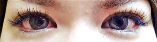 沖縄まつげエクステ・那覇まつげエクステ施術後の写真：まつげエクステ