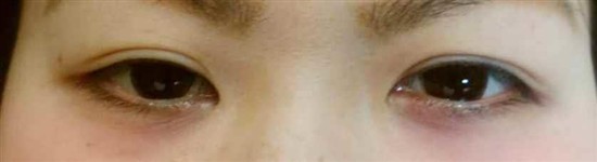 沖縄まつげエクステ・那覇まつげエクステ施術後の写真：自然なボリュームを