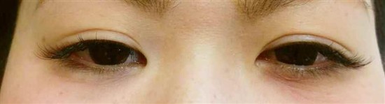 沖縄まつげエクステ・那覇まつげエクステ施術後の写真：自然なボリュームを