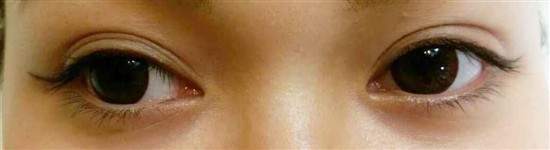 沖縄まつげエクステ・那覇まつげエクステ施術後の写真：真ん中を長めに黒め強調